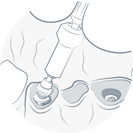 ATTACHING INSTANT ABUTMENTS
